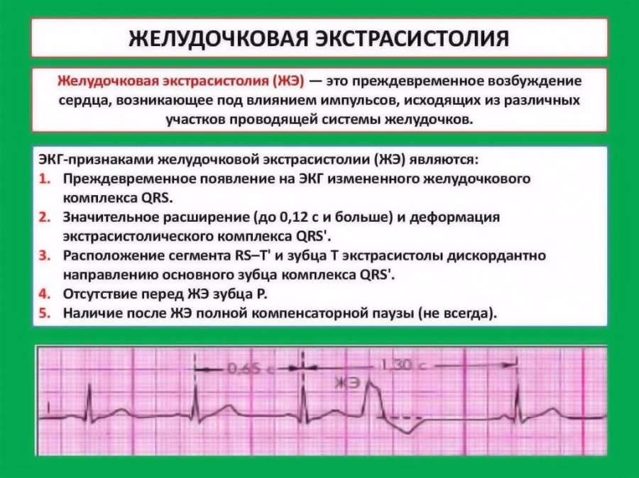 Экстрасистолия: причины, симптомы, типы, лечение